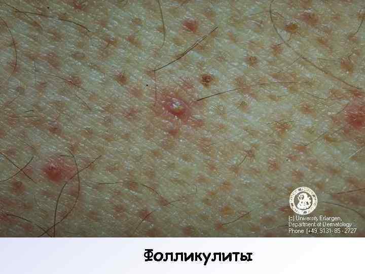 Фолликулиты 