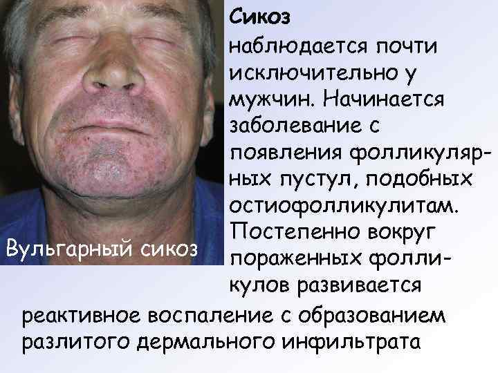     Сикоз    наблюдается почти    исключительно