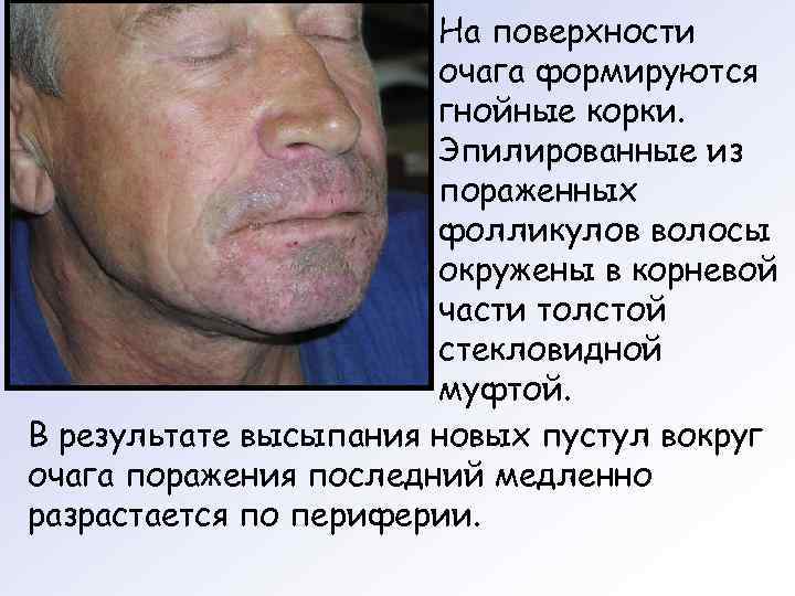     На поверхности    очага формируются   