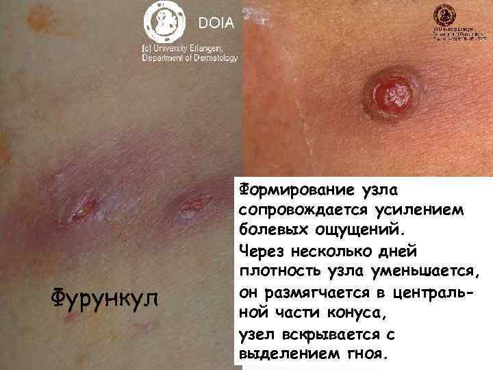   Формирование узла  сопровождается усилением  болевых ощущений.   Через несколько