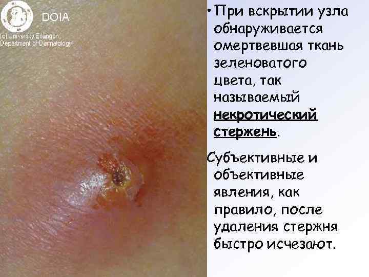  • При вскрытии узла  обнаруживается  омертвевшая ткань  зеленоватого  цвета,