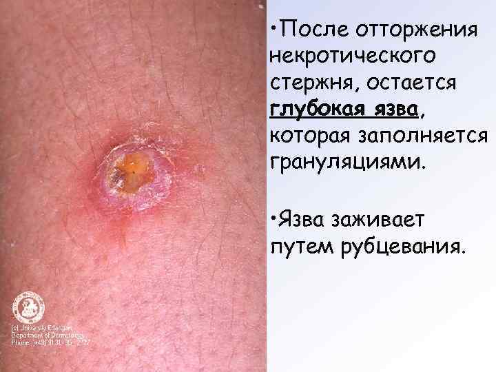  • После отторжения некротического стержня, остается глубокая язва, которая заполняется грануляциями.  •