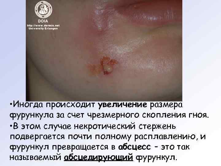  • Иногда происходит увеличение размера фурункула за счет чрезмерного скопления гноя.  •