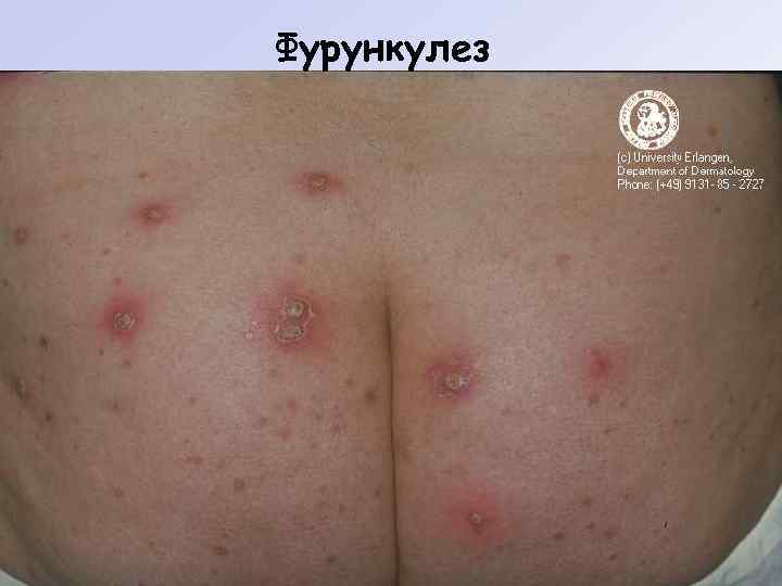 Фурункулез 