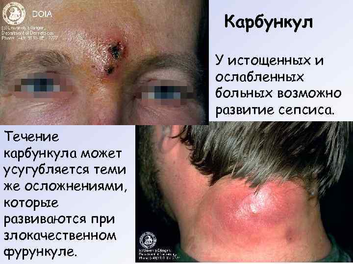      Карбункул     У истощенных и 