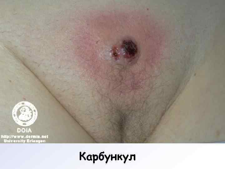 Карбункул 