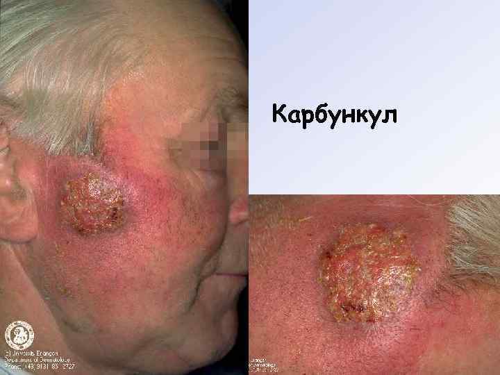 Карбункул 