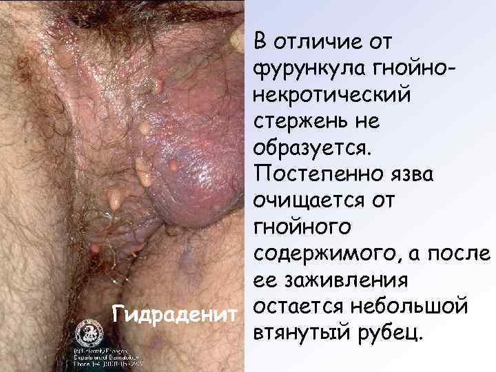   В отличие от  фурункула гнойно-  некротический  стержень не 