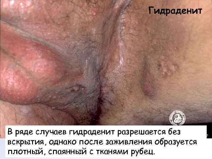       Гидраденит В ряде случаев гидраденит разрешается без вскрытия,