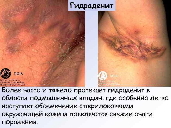    Гидраденит Более часто и тяжело протекает гидраденит в области подмышечных впадин,
