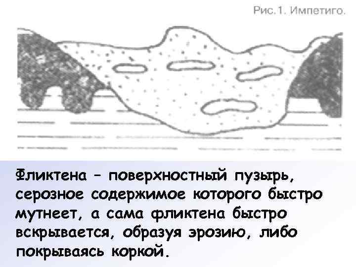 Фликтена – поверхностный пузырь, серозное содержимое которого быстро мутнеет, а сама фликтена быстро вскрывается,