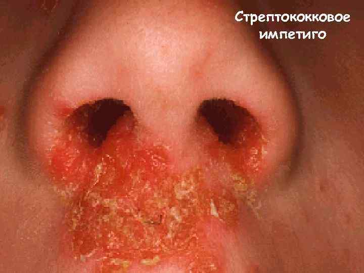 Стрептококковое  импетиго 