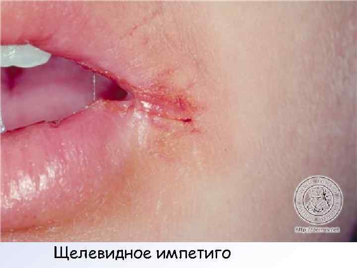 Щелевидное импетиго 