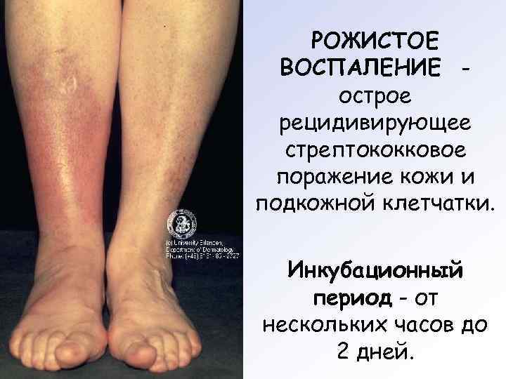  РОЖИСТОЕ  ВОСПАЛЕНИЕ -  острое  рецидивирующее  стрептококковое поражение кожи и