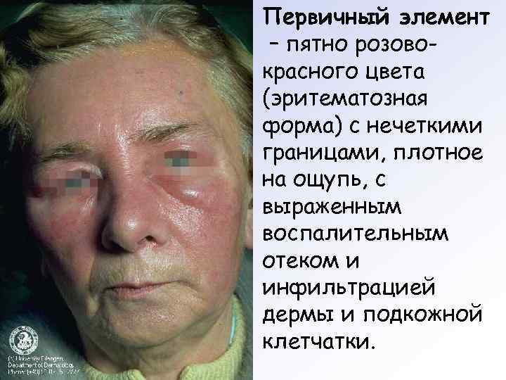 Первичный элемент – пятно розово- красного цвета (эритематозная форма) с нечеткими границами, плотное на