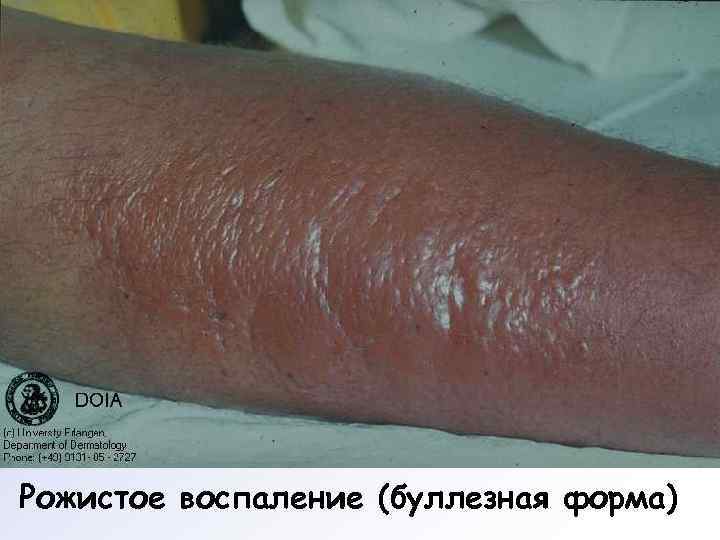 Рожистое воспаление (буллезная форма) 
