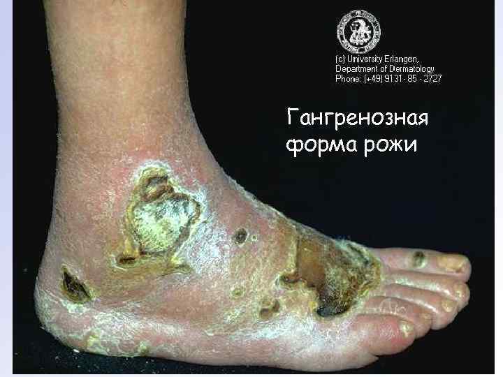 Гангренозная форма рожи 