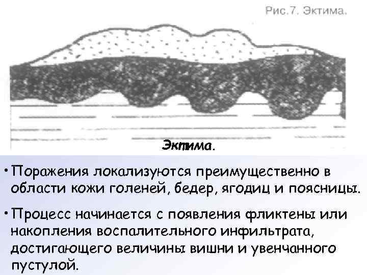      Эктима.  • Поражения локализуются преимущественно в  области