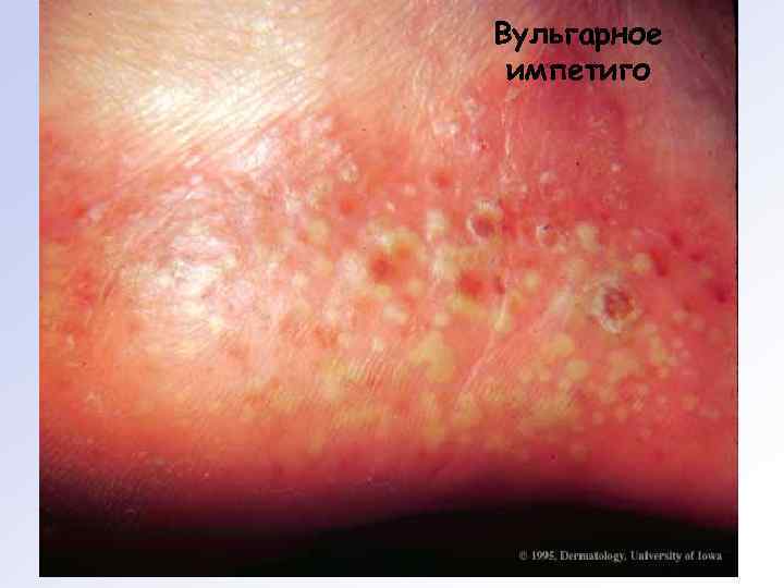 Вульгарное импетиго 
