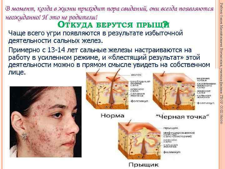 Чаще всего угри появляются в результате избыточной деятельности сальных желез. Примерно с 13 -14