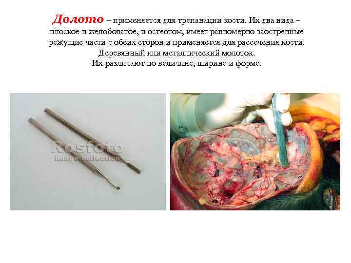 Долото – применяется для трепанации кости. Их два вида – плоское и желобоватое, и