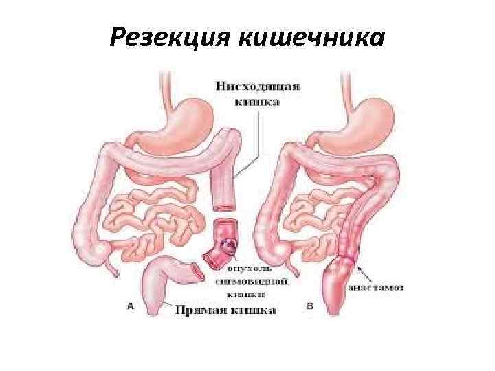 Резекция кишечника 