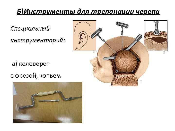  Б)Инструменты для трепанации черепа Специальный инструментарий: а) коловорот с фрезой, копьем 