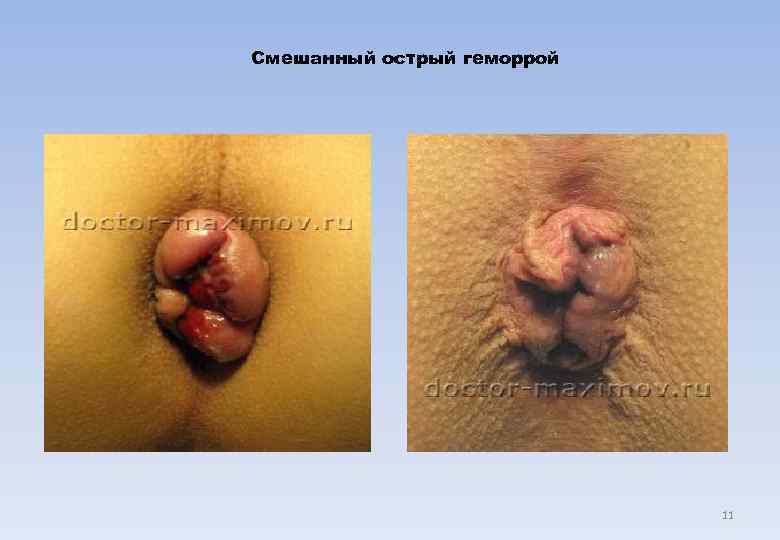 Смешанный острый геморрой       11 