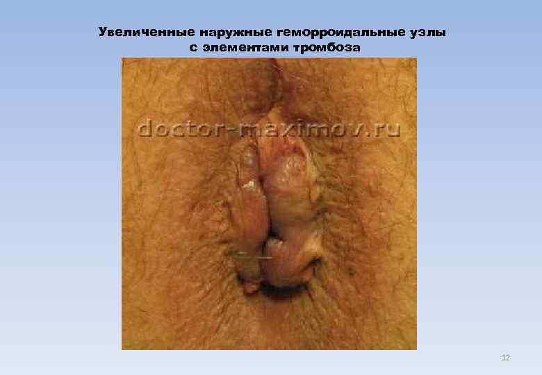 Увеличенные наружные геморроидальные узлы  с элементами тромбоза     12 