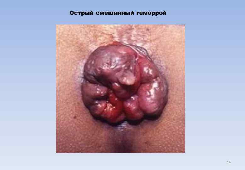 Острый смешанный геморрой       14 