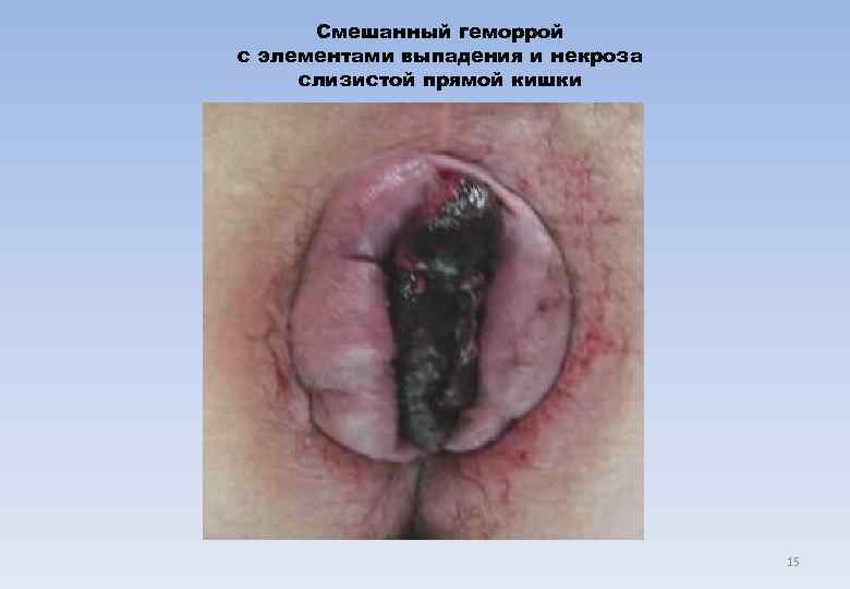  Смешанный геморрой с элементами выпадения и некроза слизистой прямой кишки   