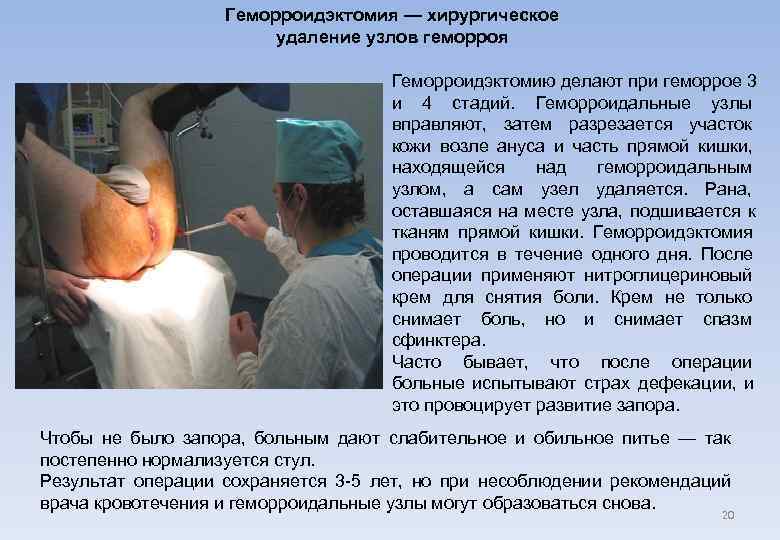     Геморроидэктомия — хирургическое     удаление узлов геморроя