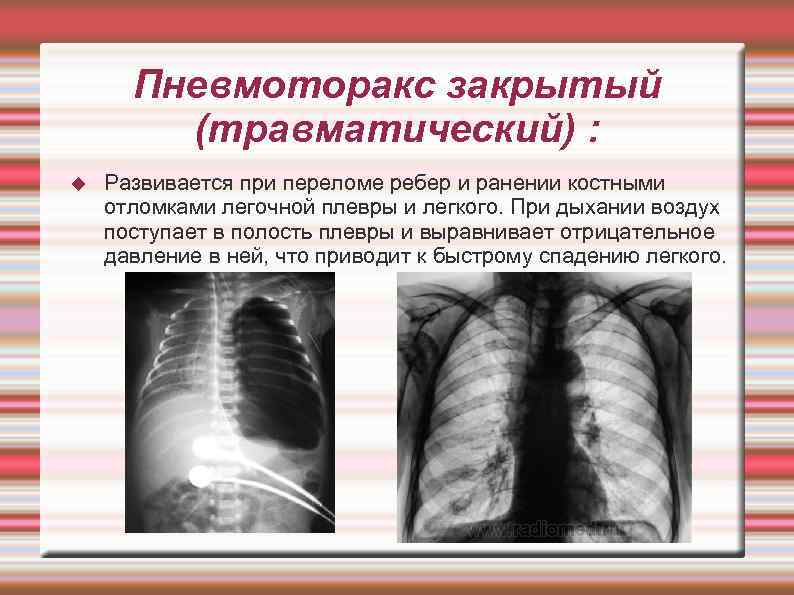  Пневмоторакс закрытый   (травматический) : Развивается при переломе ребер и ранении костными
