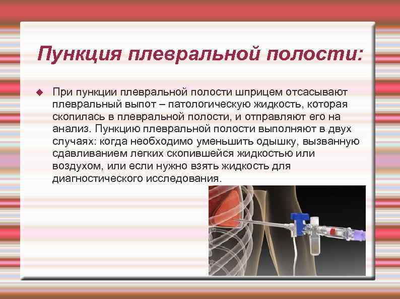 Пункция плевральной полости: При пункции плевральной полости шприцем отсасывают плевральный выпот – патологическую жидкость,