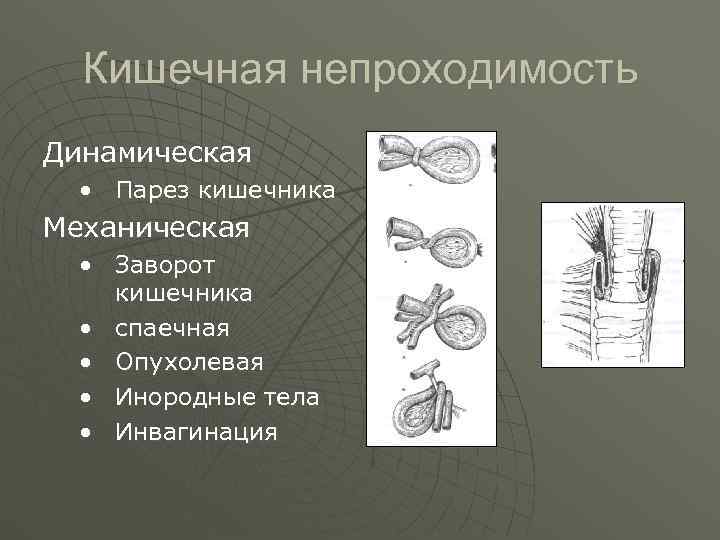  Кишечная непроходимость Динамическая  • Парез кишечника Механическая  • Заворот кишечника 