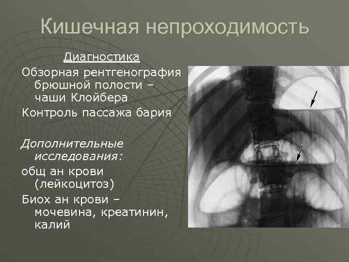  Кишечная непроходимость  Диагностика Обзорная рентгенография  брюшной полости –  чаши Клойбера