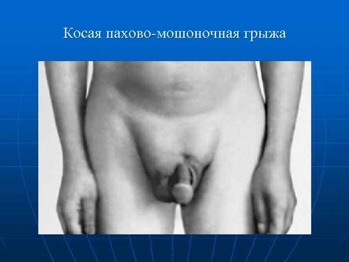 Косая пахово-мошоночная грыжа 