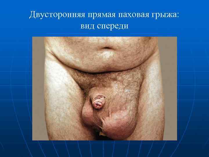 Двусторонняя прямая паховая грыжа:   вид спереди 