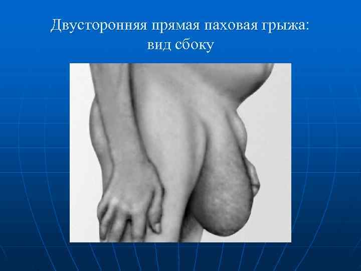 Двусторонняя прямая паховая грыжа:   вид сбоку 