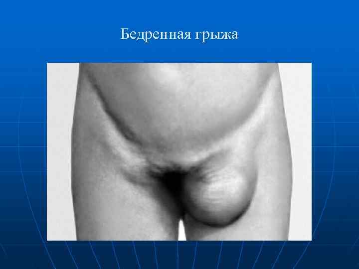 Бедренная грыжа 
