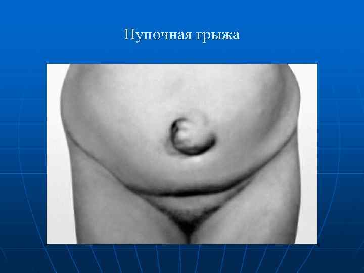Пупочная грыжа 