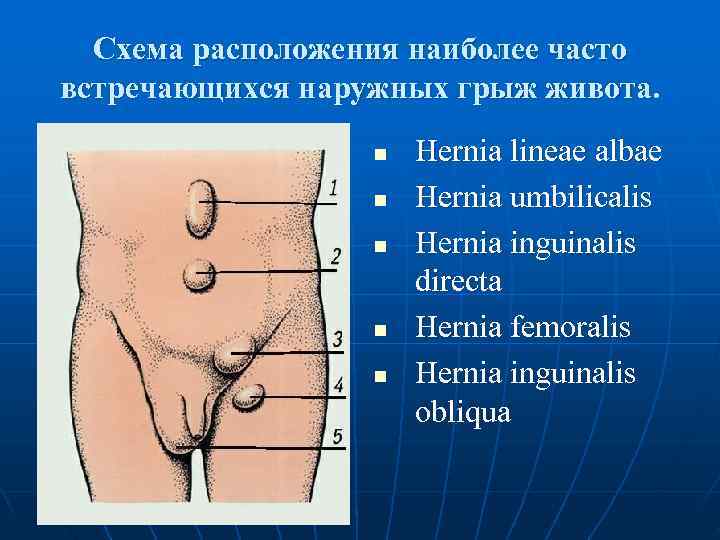  Схема расположения наиболее часто встречающихся наружных грыж живота.    n 