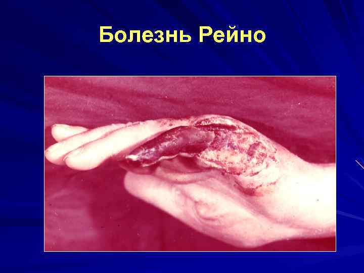 Болезнь Рейно 