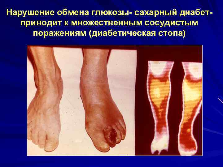 Нарушение обмена глюкозы- сахарный диабетприводит к множественным сосудистым поражениям (диабетическая стопа) 