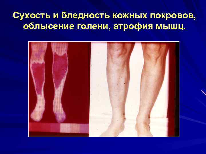 Сухость и бледность кожных покровов, облысение голени, атрофия мышц. 
