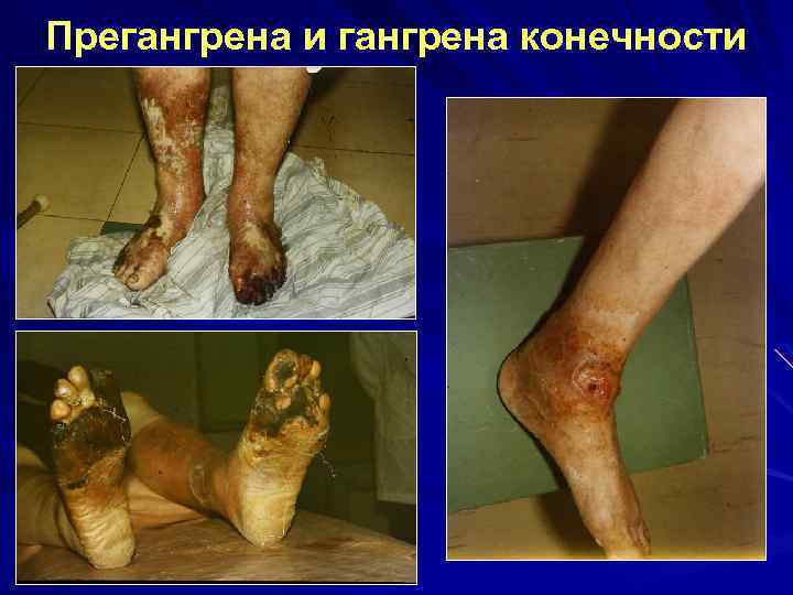 Прегангрена и гангрена конечности 