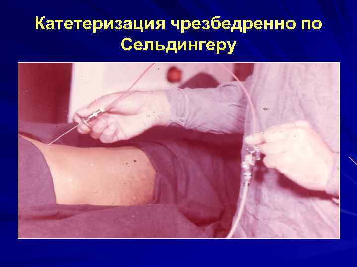 Катетеризация чрезбедренно по Сельдингеру 