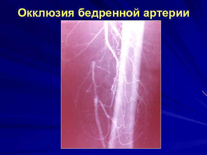 Окклюзия бедренной артерии 