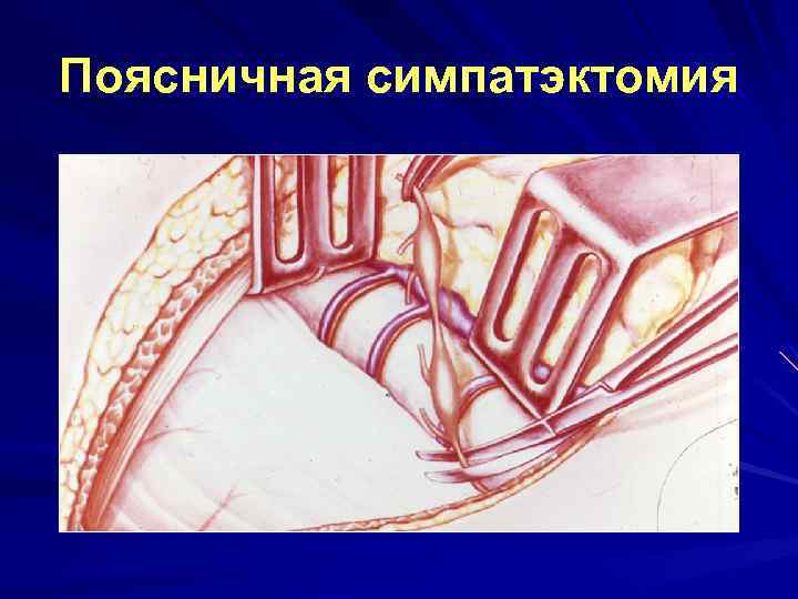 Поясничная симпатэктомия 