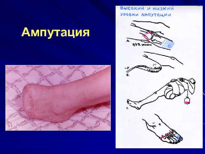 Ампутация 